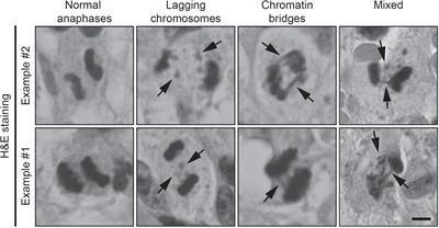 Investigating chromosomal instability in long-term survivors with glioblastoma and grade 4 astrocytoma